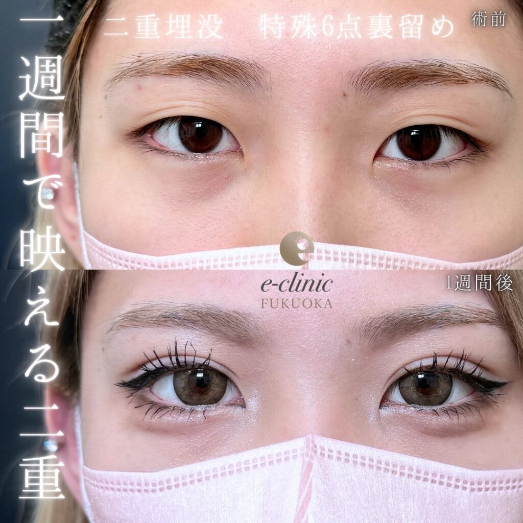 埋没法の症例写真 (10)