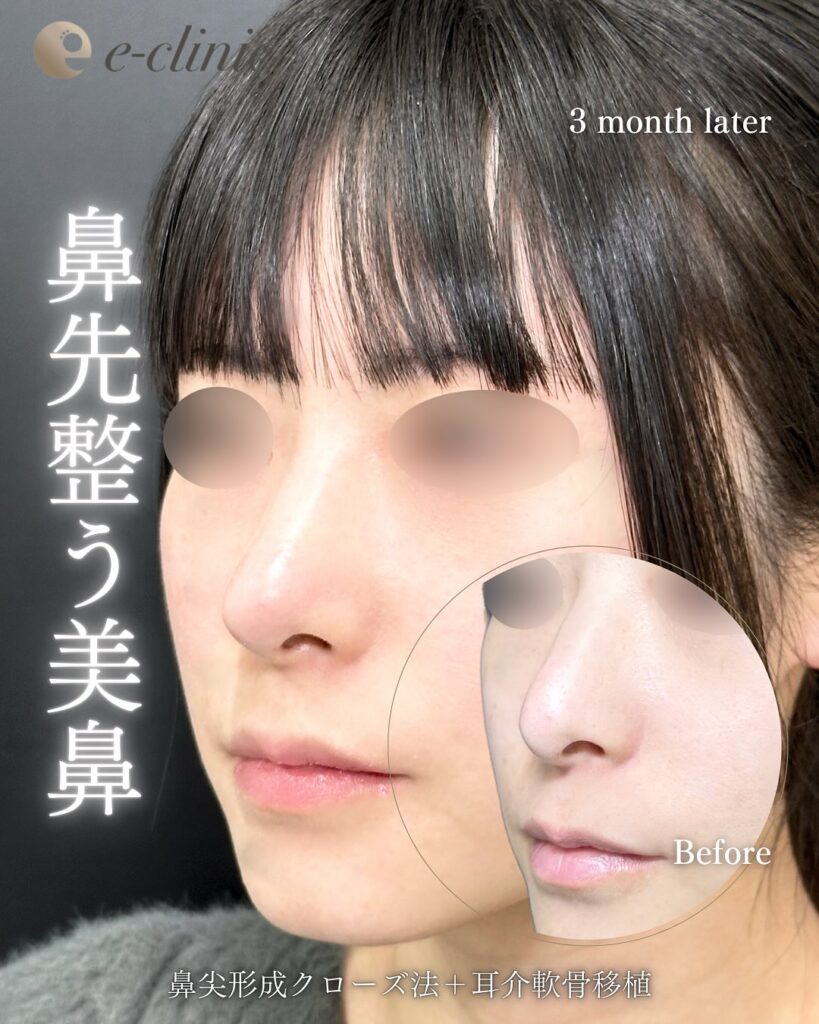 鼻尖形成+軟骨移植の症例写真 (1)