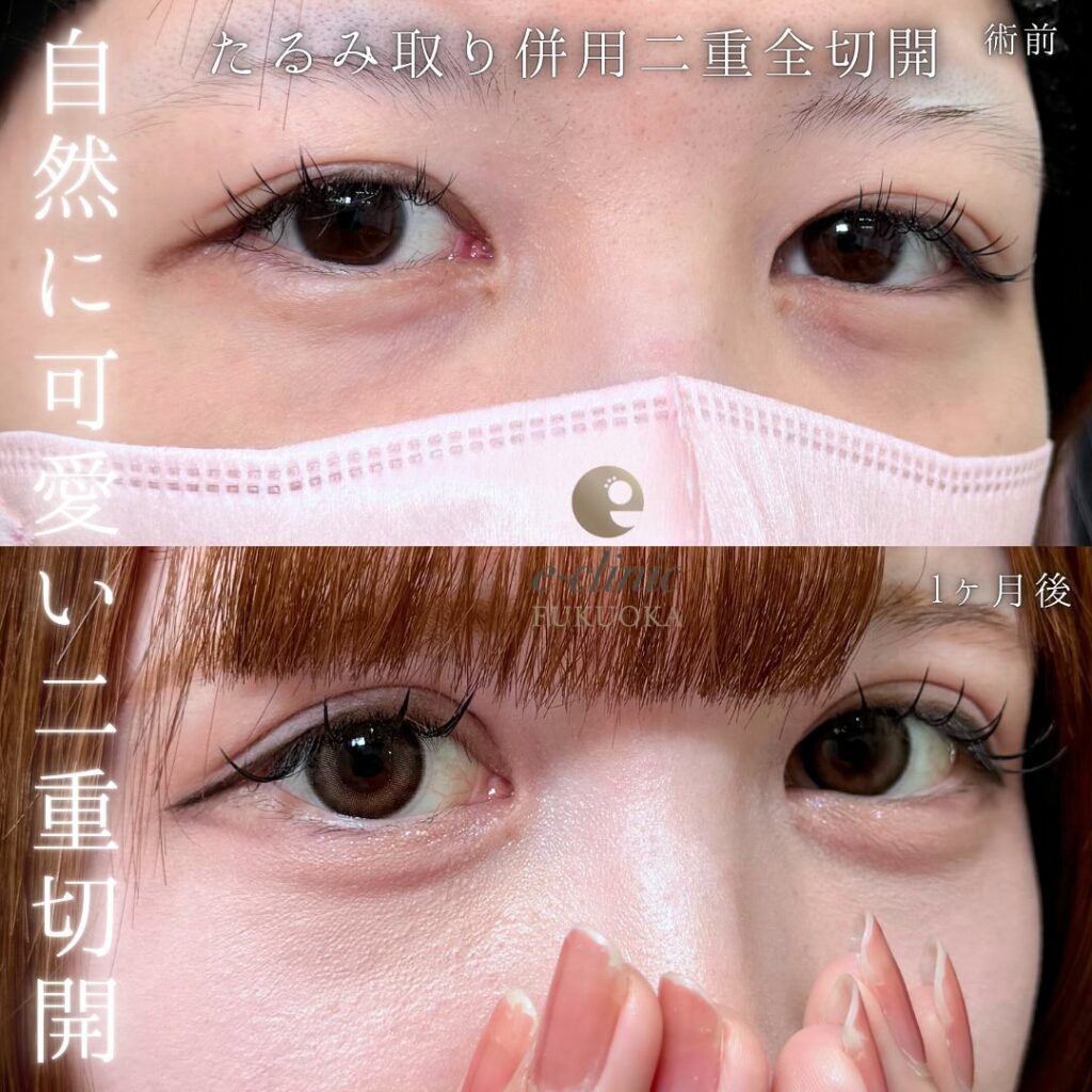 たるみ取り併用全切開の症例写真 (2)