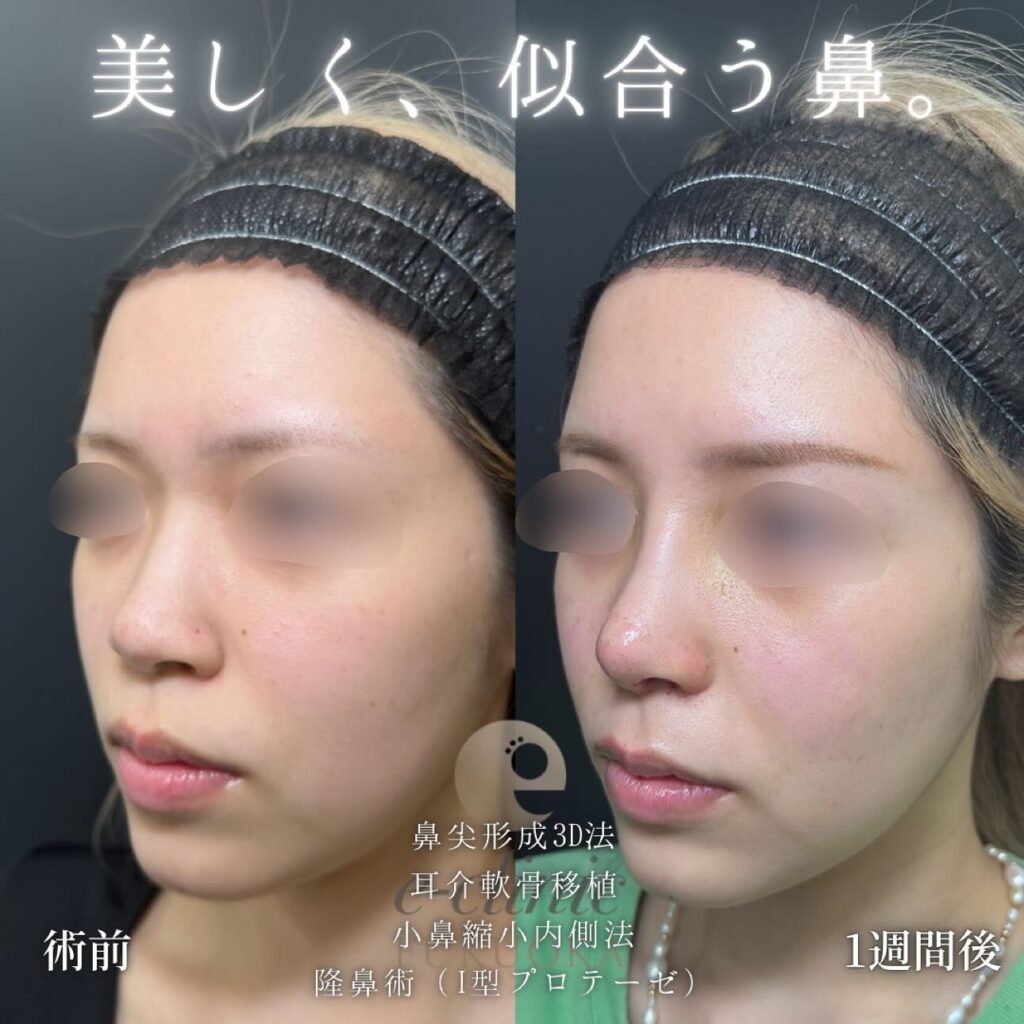鼻尖形成と軟骨移植と小鼻縮小とプロテーゼの症例写真 (3)