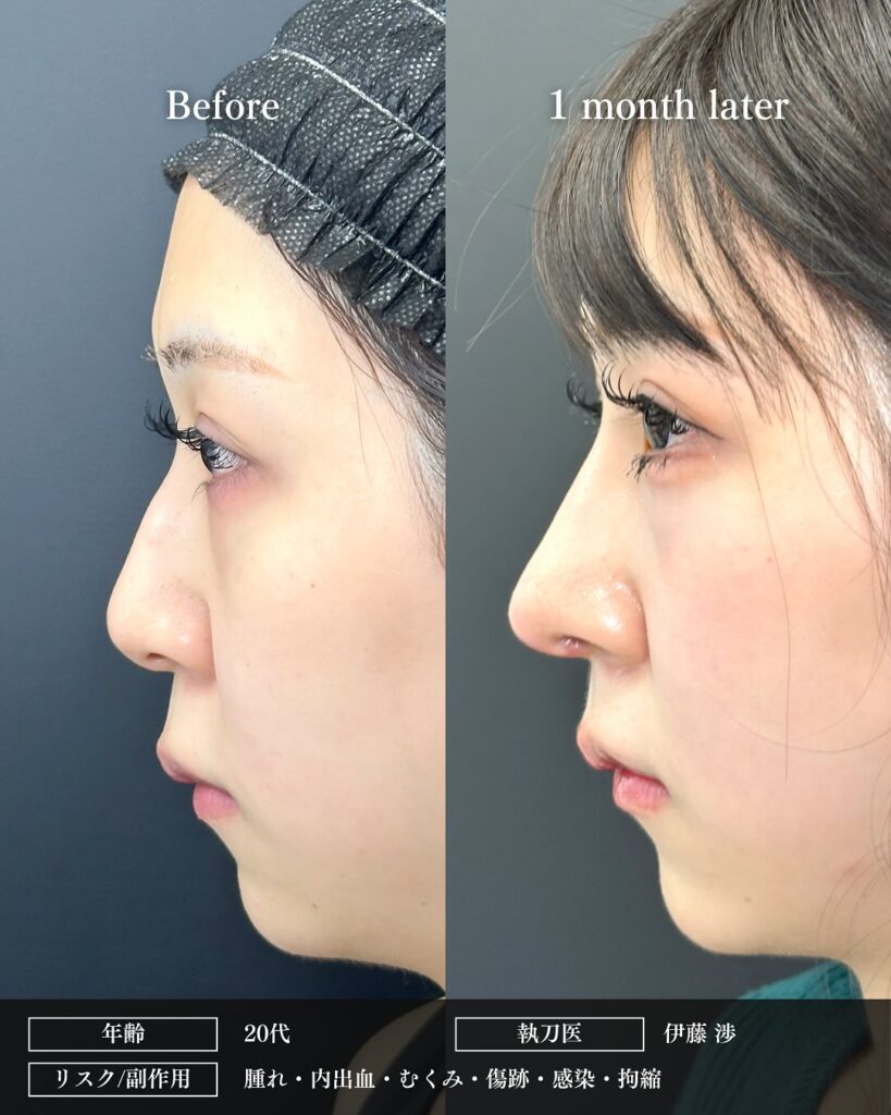 鼻中隔延長と鼻尖形成と軟骨移植と鷲鼻修正の症例写真 (2)