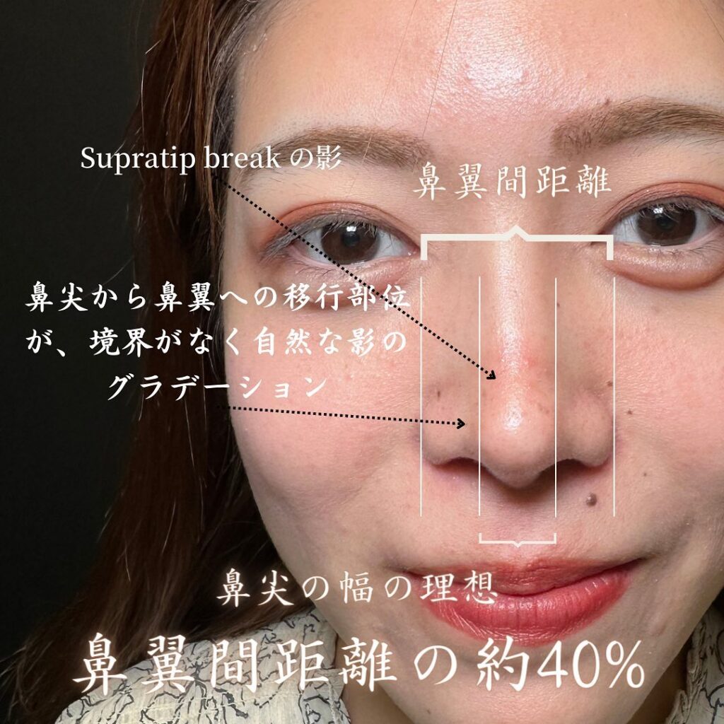 鼻中隔延長と鼻尖形成と耳介軟骨移植とプロテーゼと他院修正の症例写真 (3)