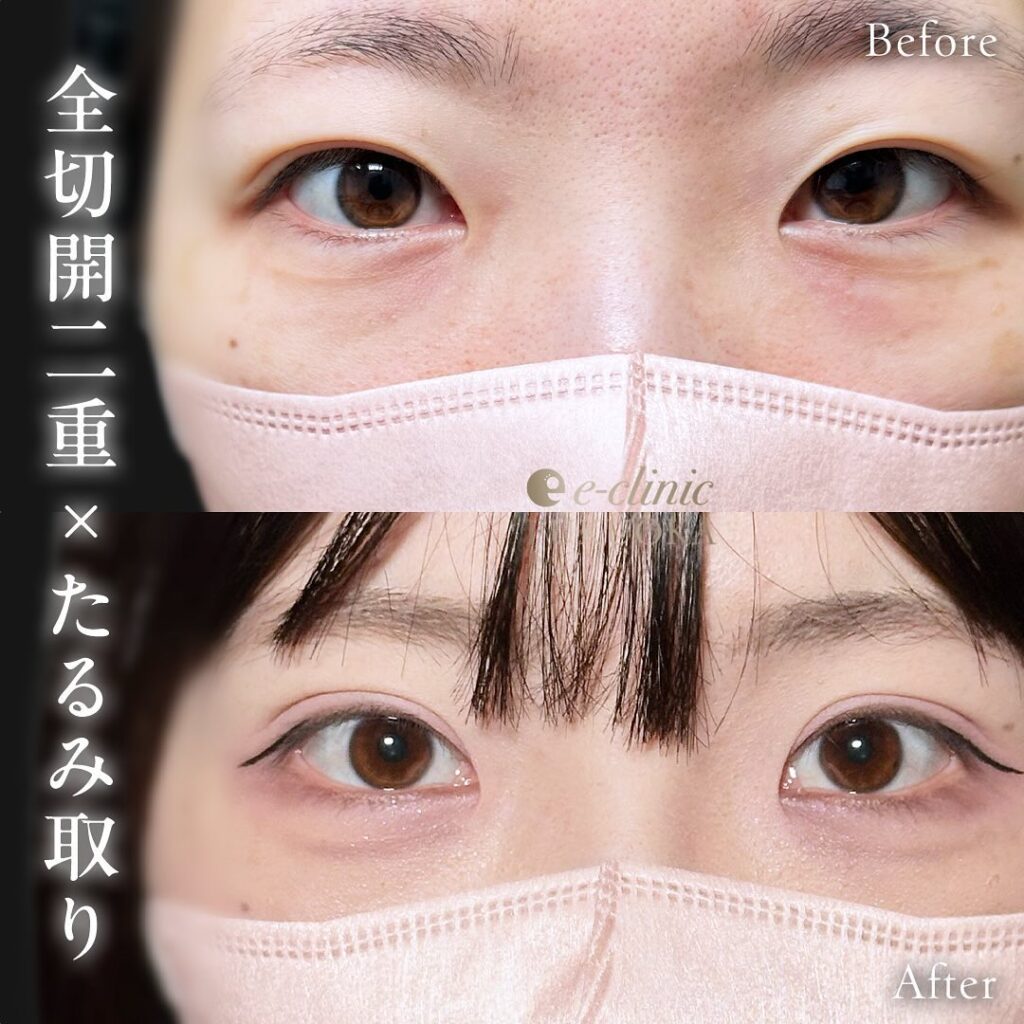 たるみ取り併用全切開の症例写真 (5)