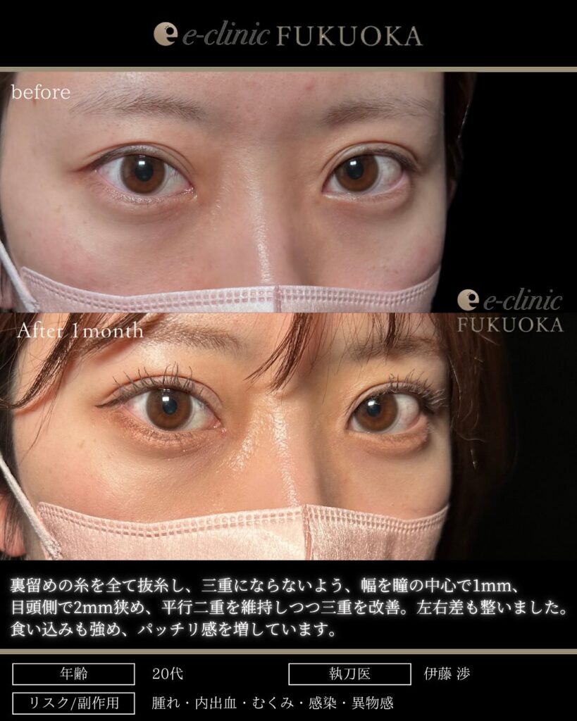 他院埋没裏留め抜糸と埋没法の症例写真 (1)