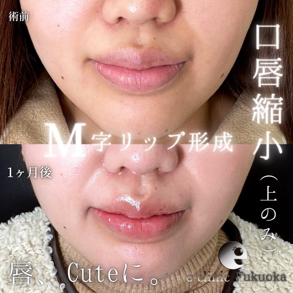 唇縮小の症例写真 (1)