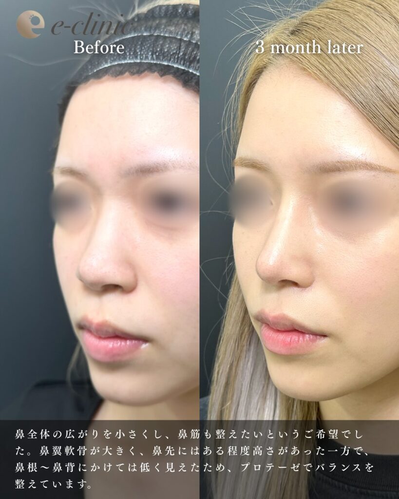 鼻尖形成と軟骨移植とプロテーゼと小鼻縮小の症例写真 (16)