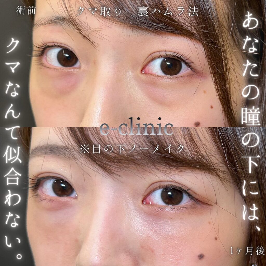 裏ハムラ法の症例写真 (49)