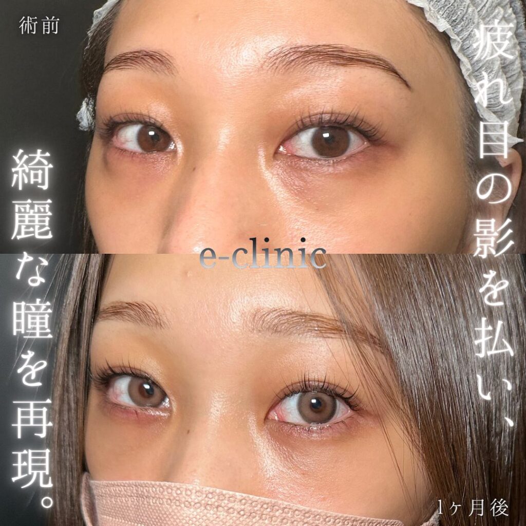 裏ハムラ法と涙袋と目の下のヒアルロン酸の症例写真 (3)