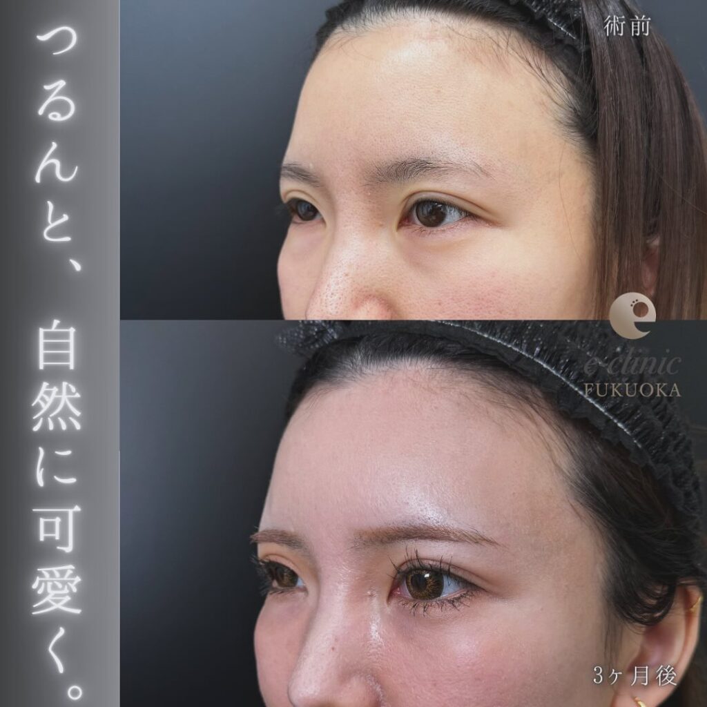 裏ハムラ方と脂肪注入の症例写真 (2)