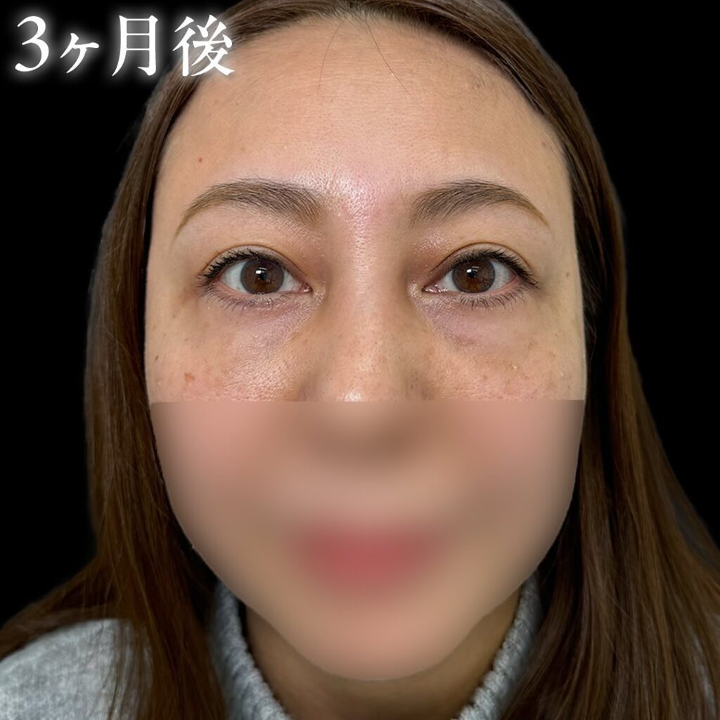 目の下のクマ取りと裏ハムラ法と目の下の脂肪注入の症例写真 (2)