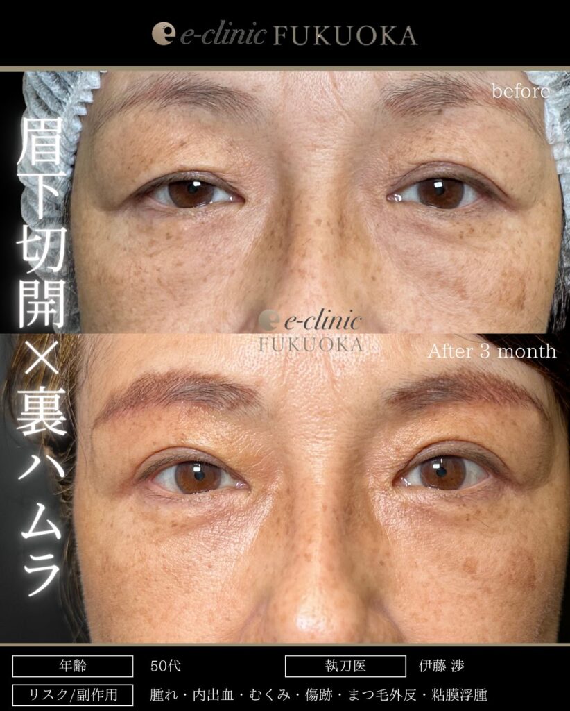 眉下切開と裏ハムラ法と目の下の脂肪注入の症例写真 (1)