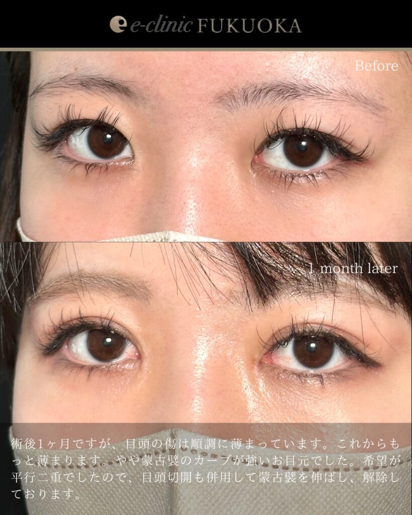 自然癒着法と目頭切開の症例写真 (6)