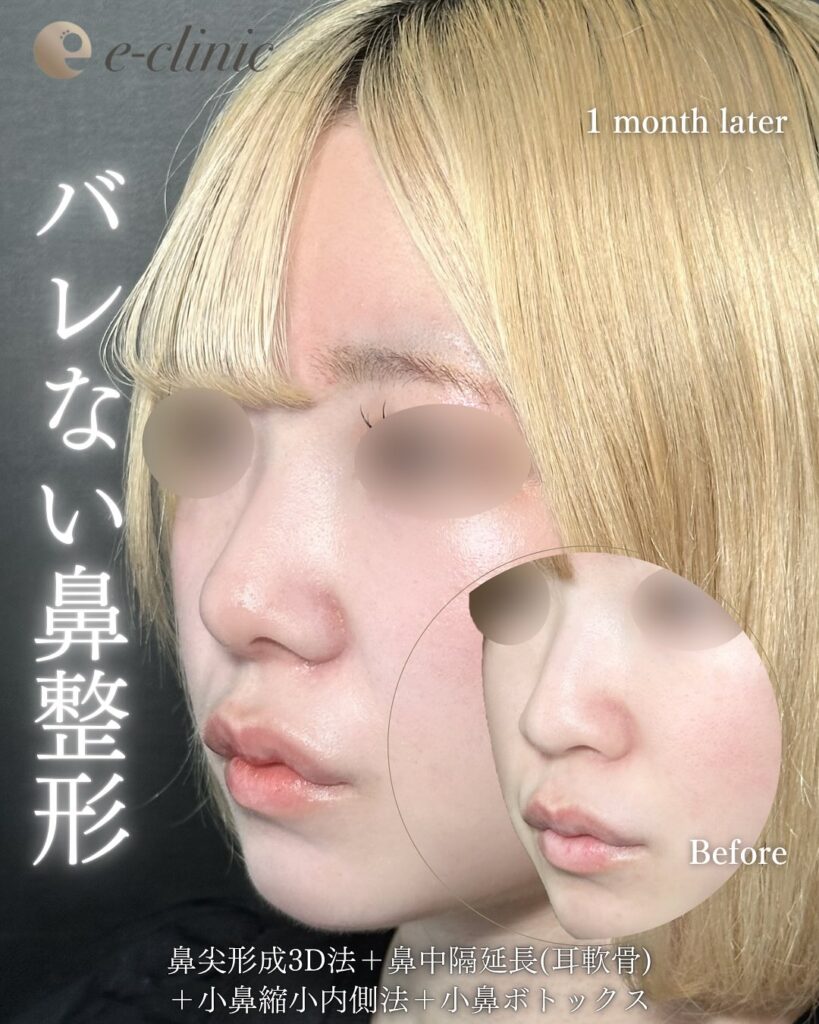 小鼻縮小と小鼻ボトックスと鼻尖形成と鼻中隔延長と軟骨移植の症例写真 (1)