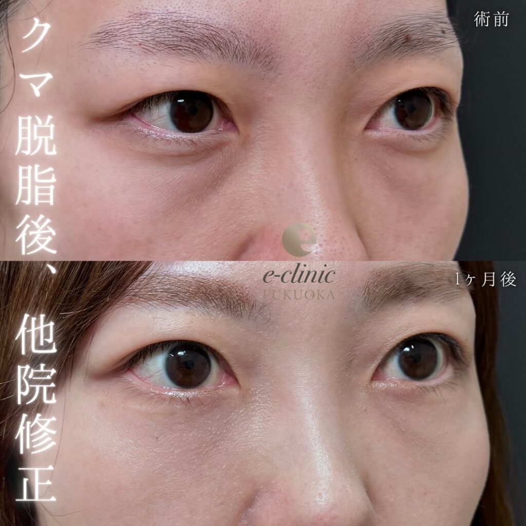 裏ハムラ法とナノリッチの症例写真 (12)