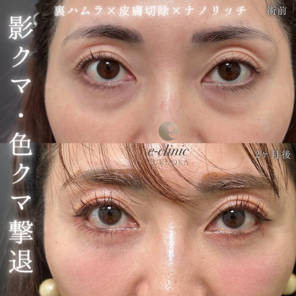 腫れ・内出血・傷跡・だるさ・熱感・頭痛・痒み・浮腫・発熱等を生じる事があります。 なるべく、リスクや副作用が出ないように配慮して手術を行っています。