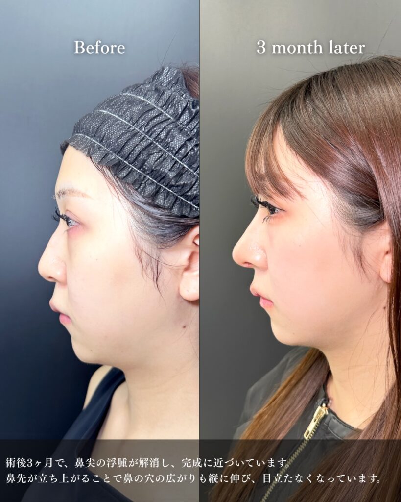 鼻中隔延長と鼻尖形成と軟骨移植と鷲鼻修正の症例写真 (10)