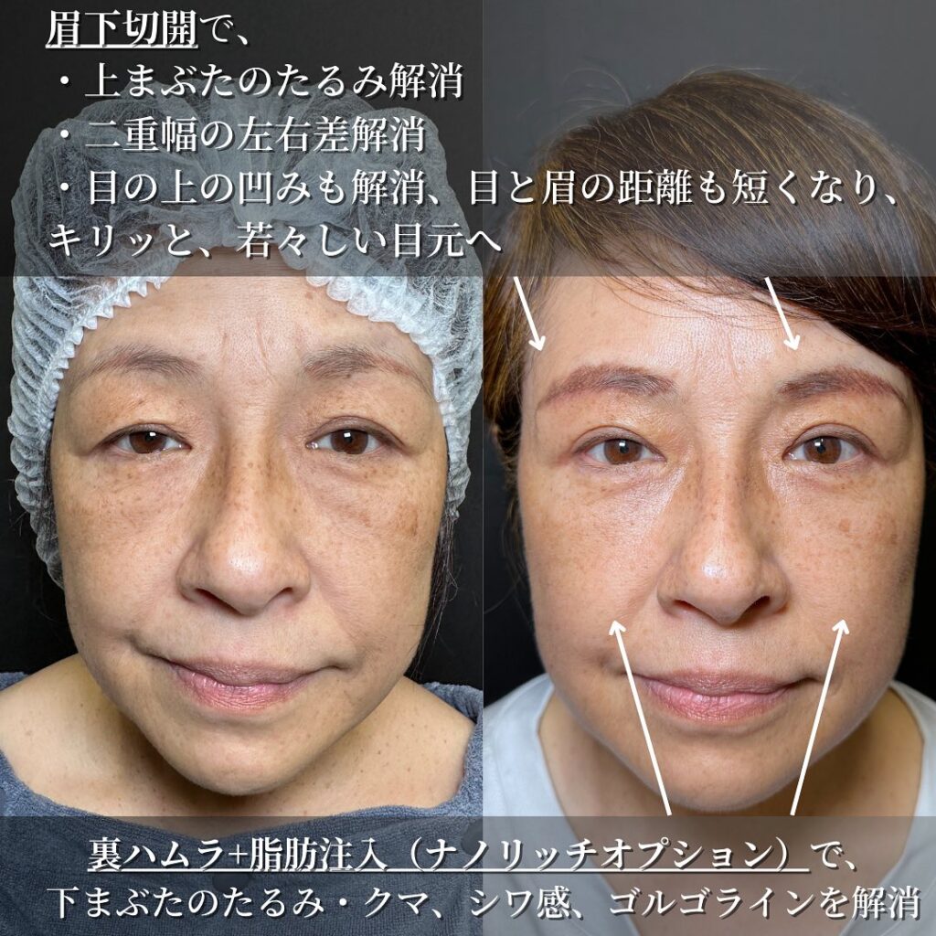 裏ハムラ法と脂肪注入と眉下切開の症例写真 (4)