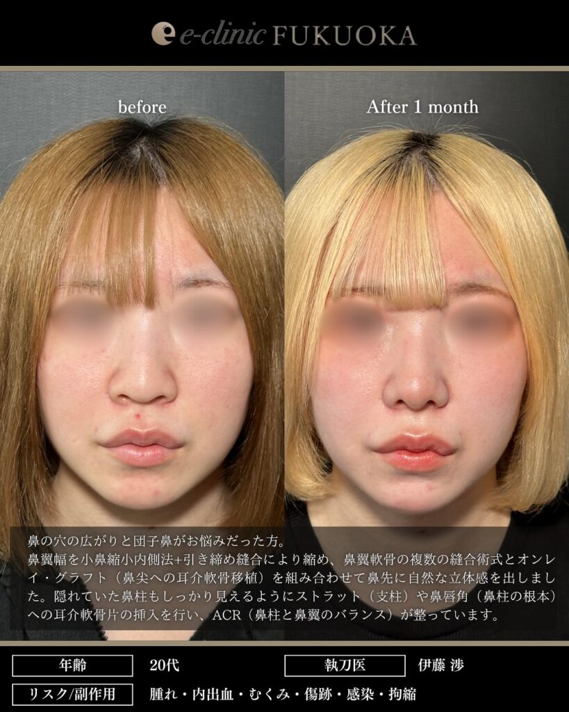 鼻尖形成と軟骨移植と小鼻縮小の症例写真 (26)