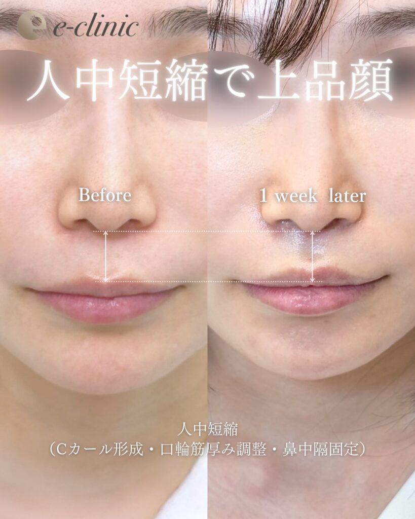 人中短縮の症例写真 (16)