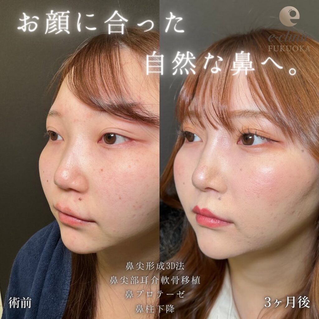 鼻尖形成と軟骨移植と耳介軟骨移植と鼻柱下降の症例写真 (1)