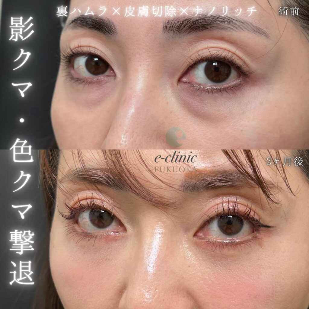 裏ハムラ法と目の下の脂肪注入の症例写真 (3)