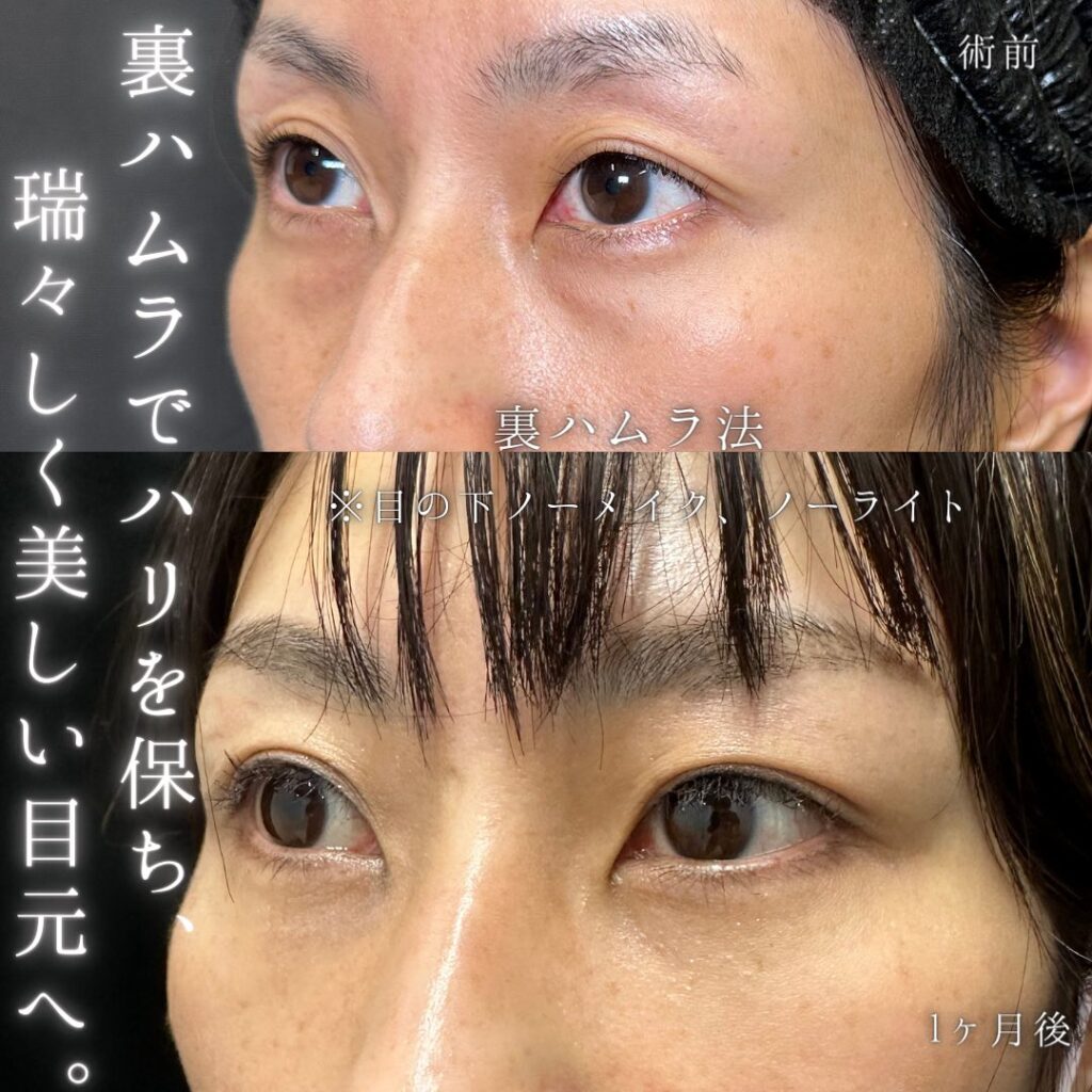 裏ハムラ法の症例写真 (53)