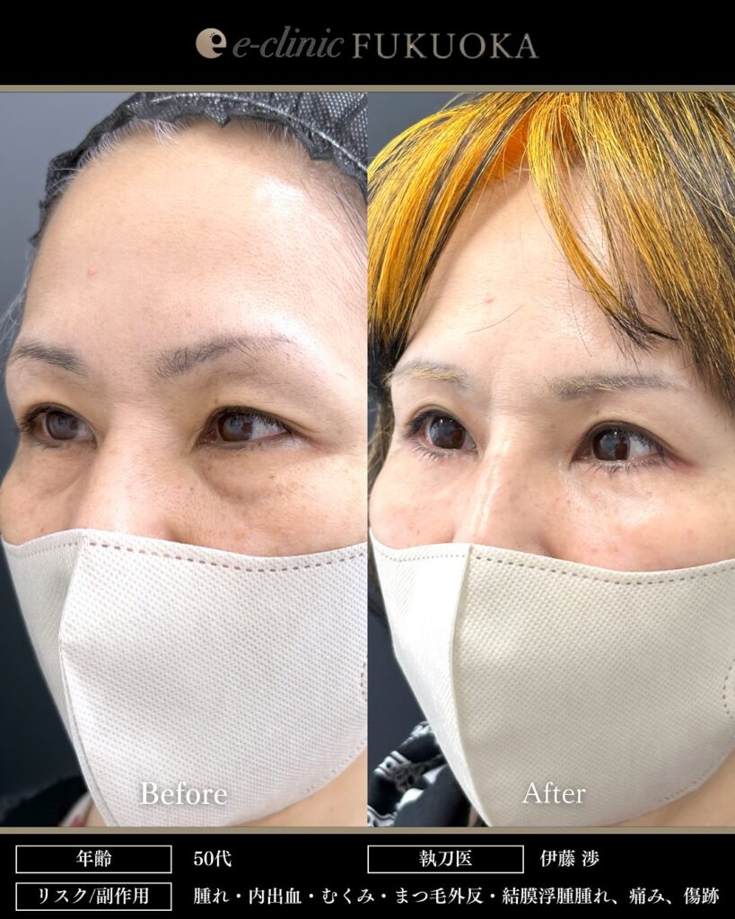 裏ハムラ法と眉下切開の症例写真 (3)