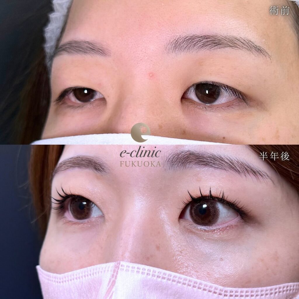 眉下切開の症例写真 (7)