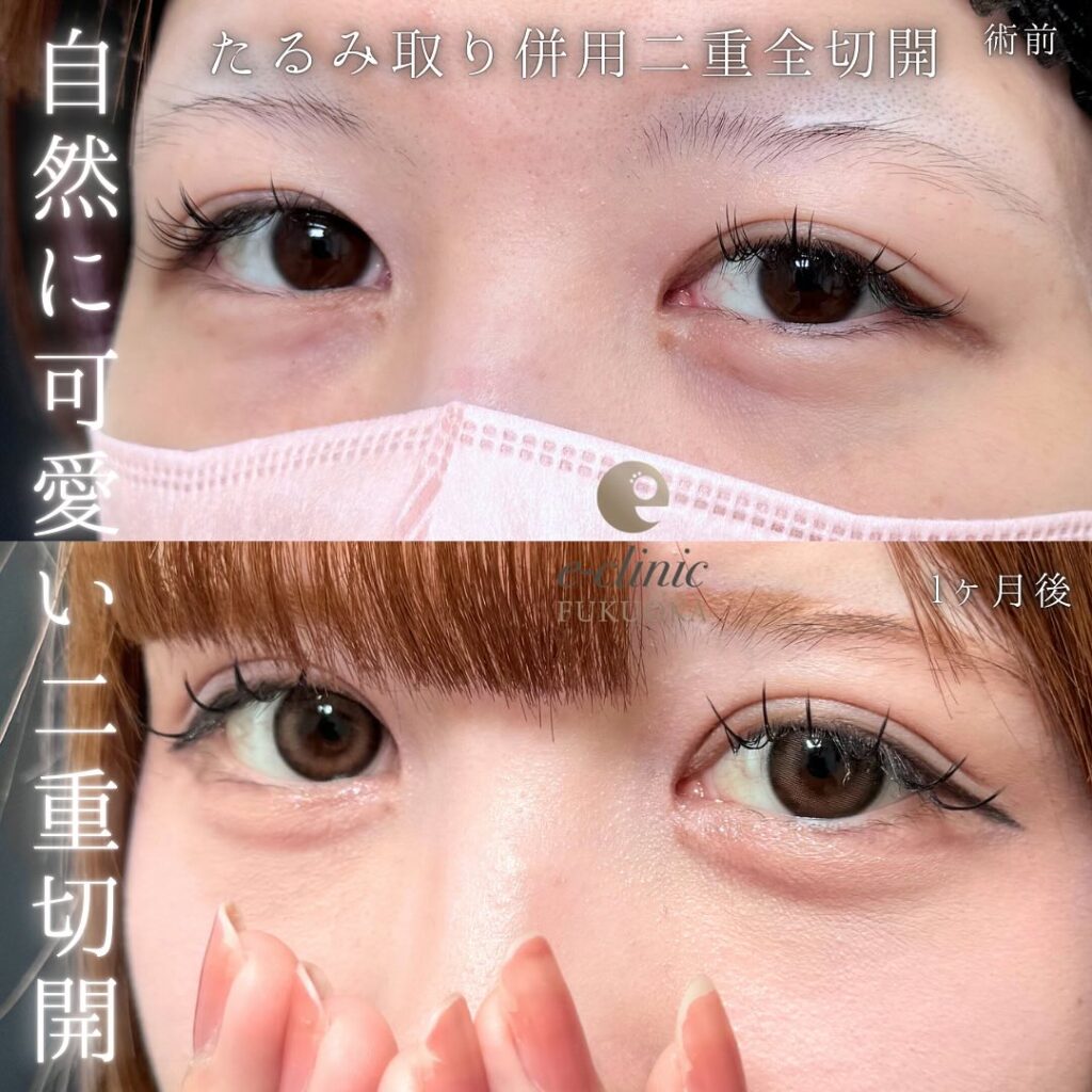 たるみ取り併用全切開の症例写真 (3)