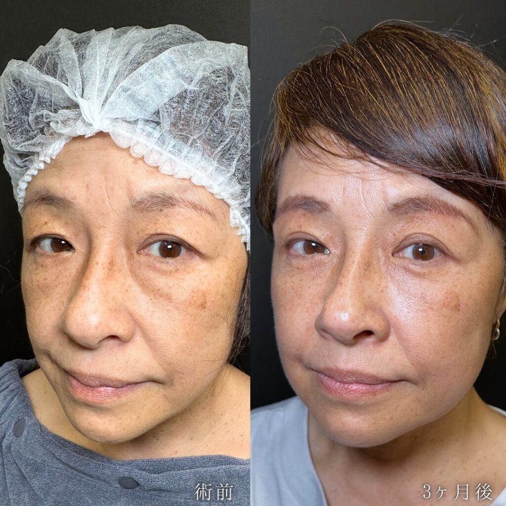 裏ハムラ法と脂肪注入と眉下切開の症例写真 (2)