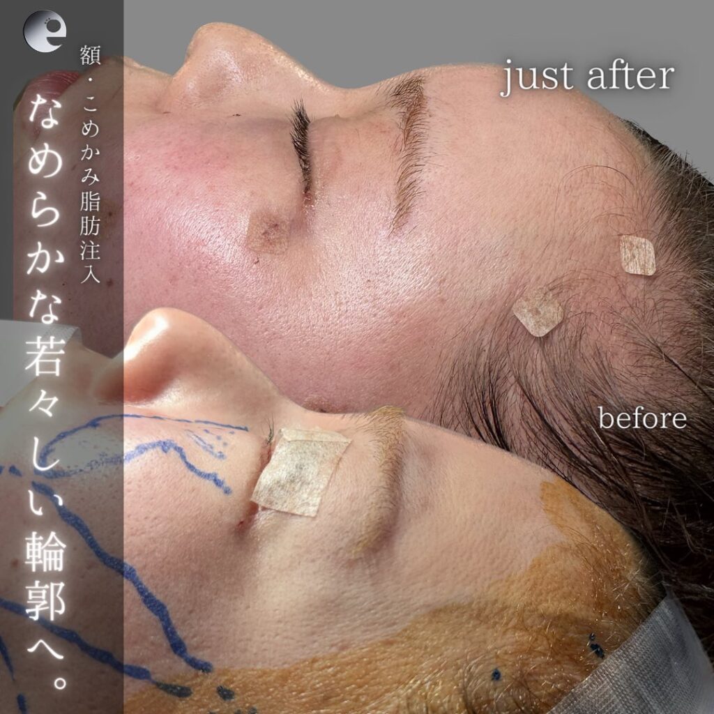 額とこめかみの脂肪注入の症例写真