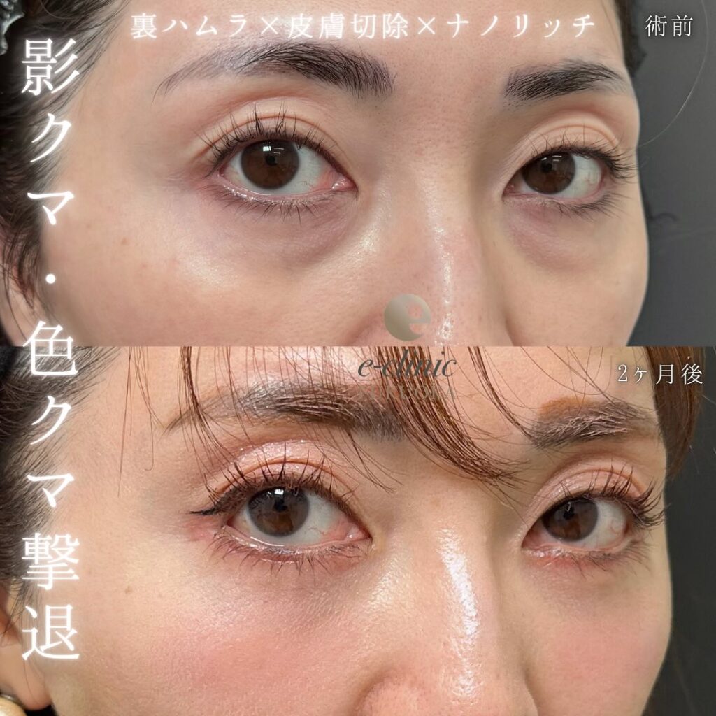 裏ハムラ法と目の下の脂肪注入の症例写真 (2)