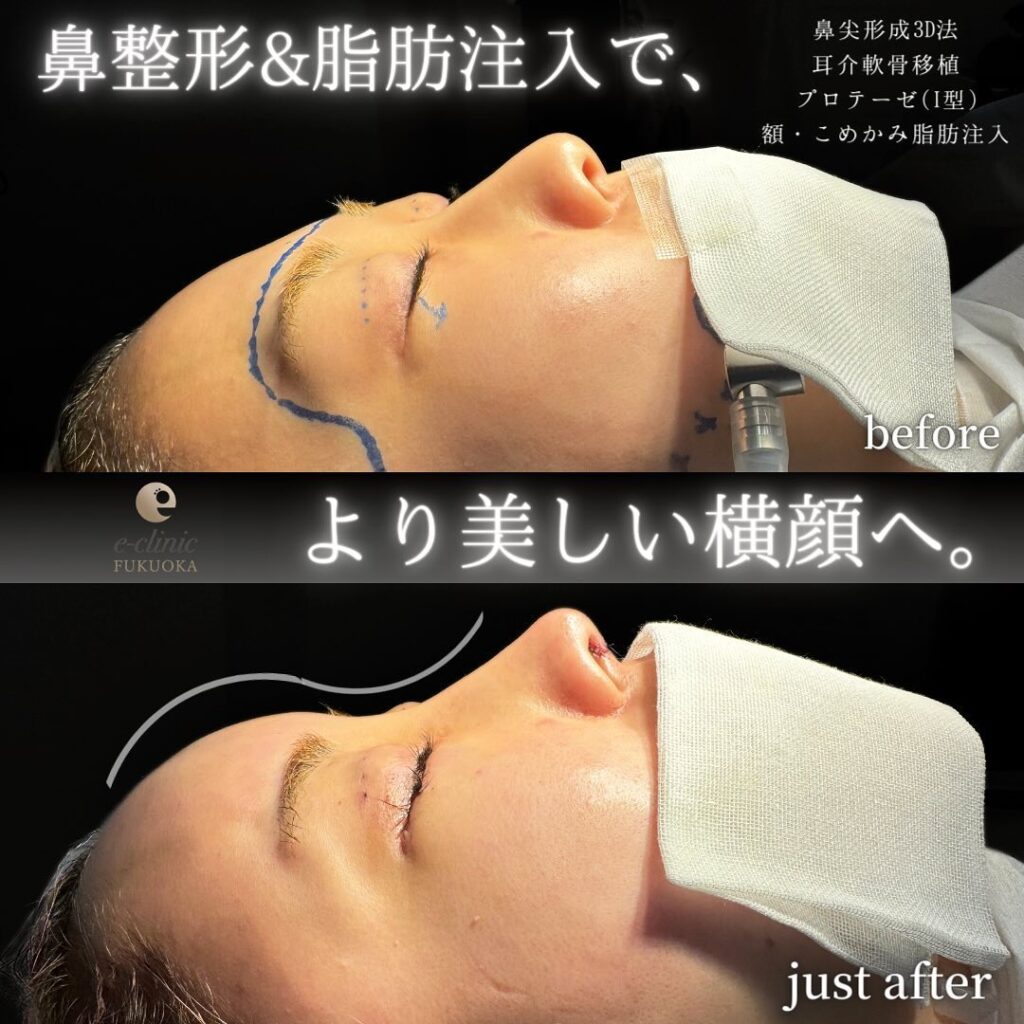 鼻尖形成と軟骨移植とプロテーゼーと額とこめかみの脂肪注入の症例写真