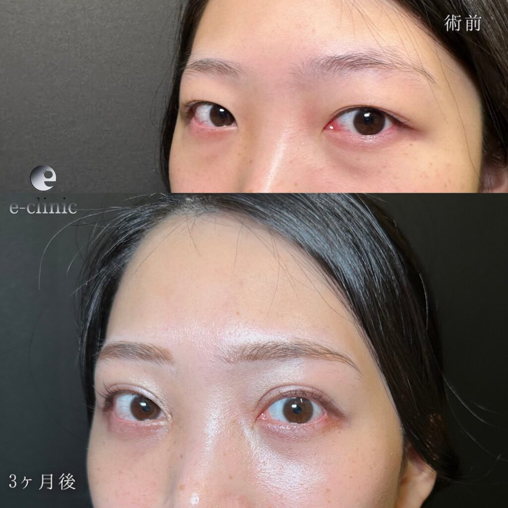 目の全方向拡大と脱脂の症例写真 (1)