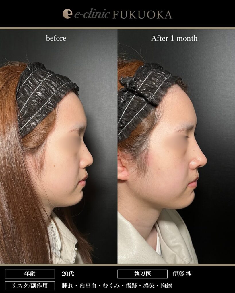 鼻中隔延長と鼻尖形成と耳介軟骨移植とプロテーゼと小鼻縮小の症例写真 (2)