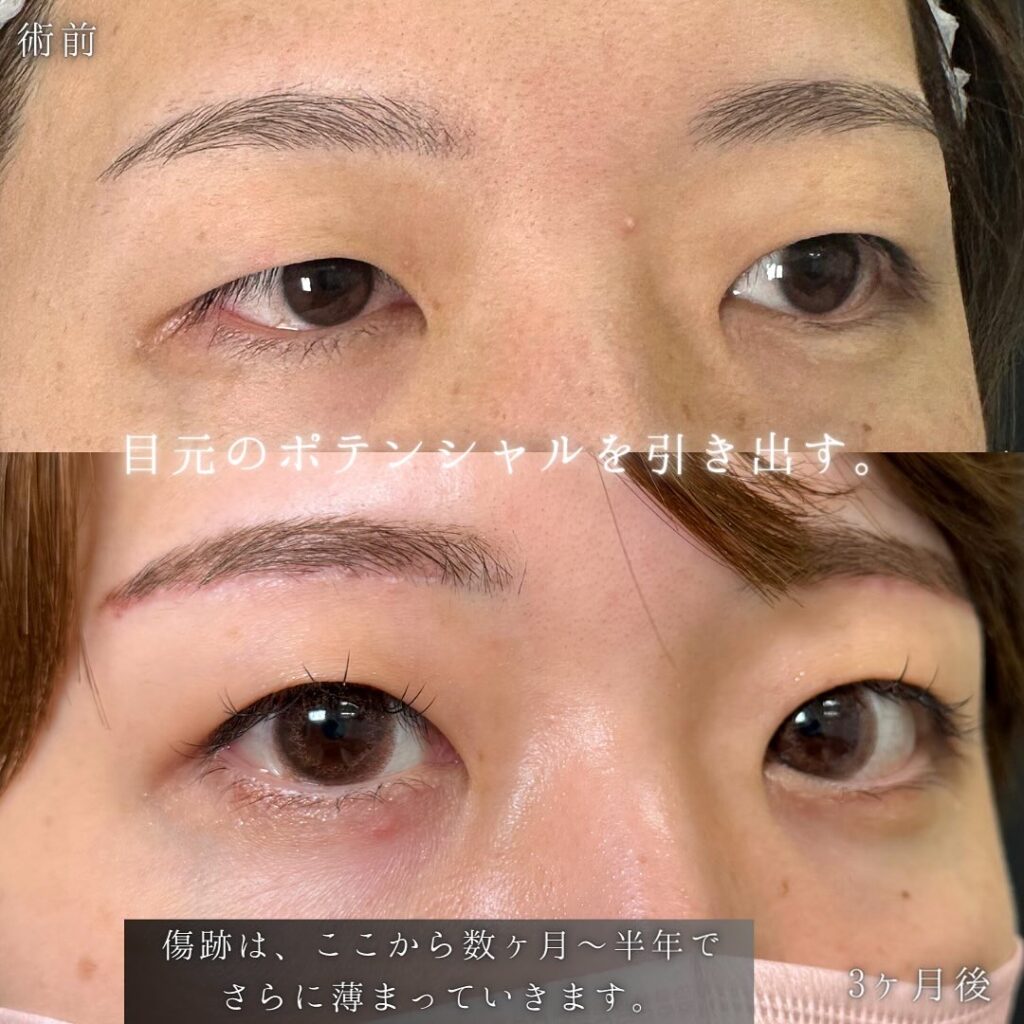 眉下切開の症例写真 (3)