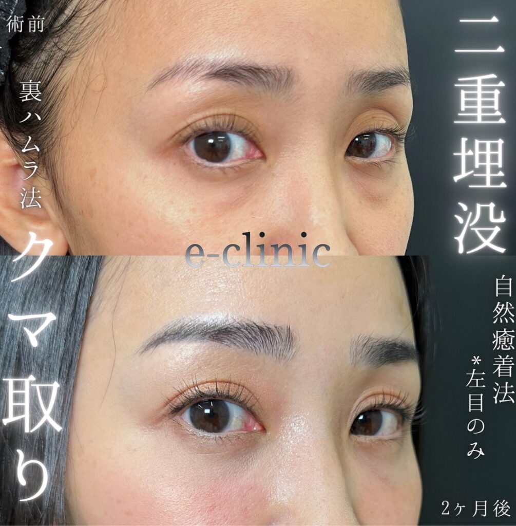 埋没法と裏ハムラ法の症例 (2)