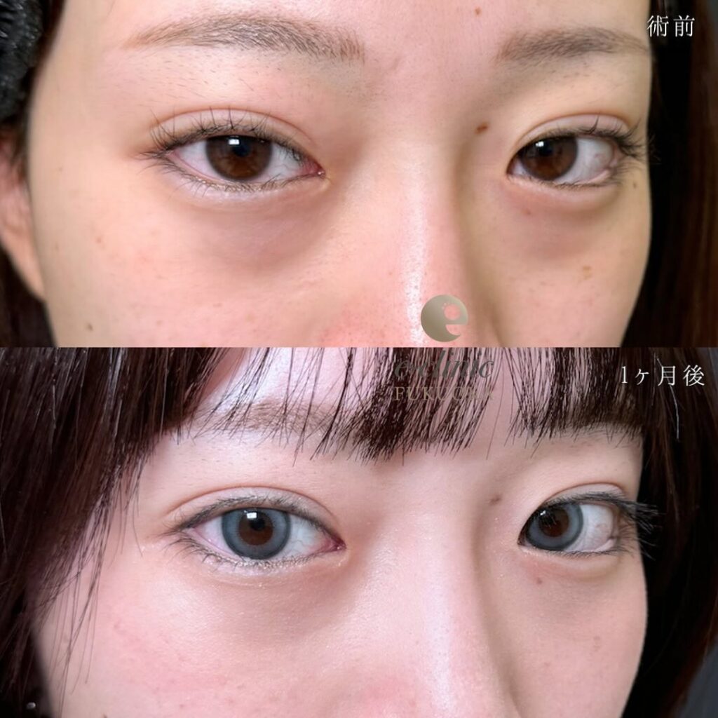 裏ハムラ法と脂肪注入の症例写真 (27)