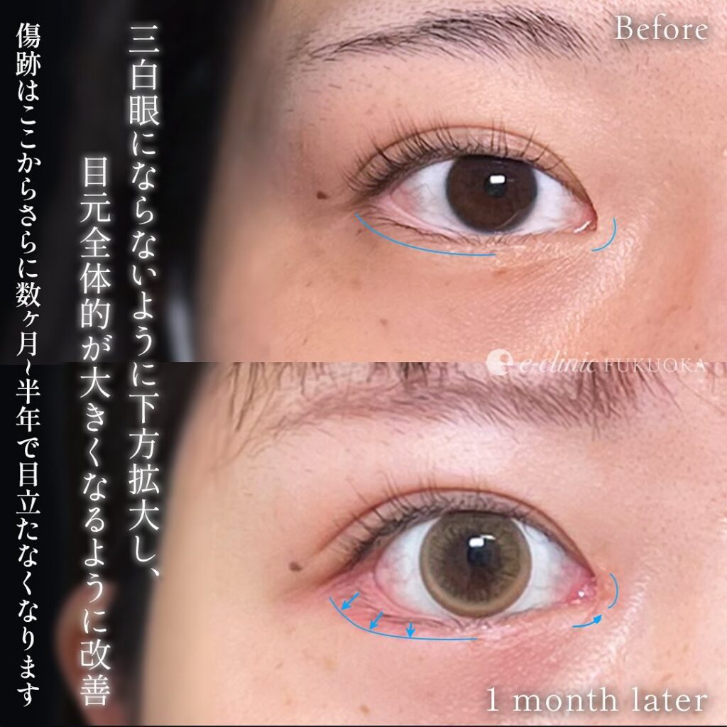 タレ目形と目頭切開と目尻切開の症例写真 (3)