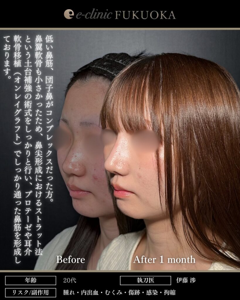 鼻尖形成と耳介軟骨移植と鼻のプロテーゼの症例写真 (4)