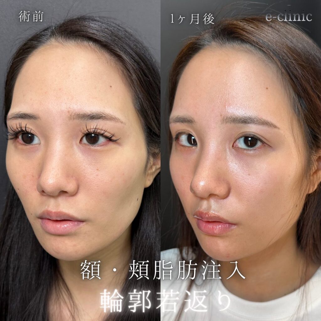 頬と額の脂肪注入と目尻切開の症例写真 (5)