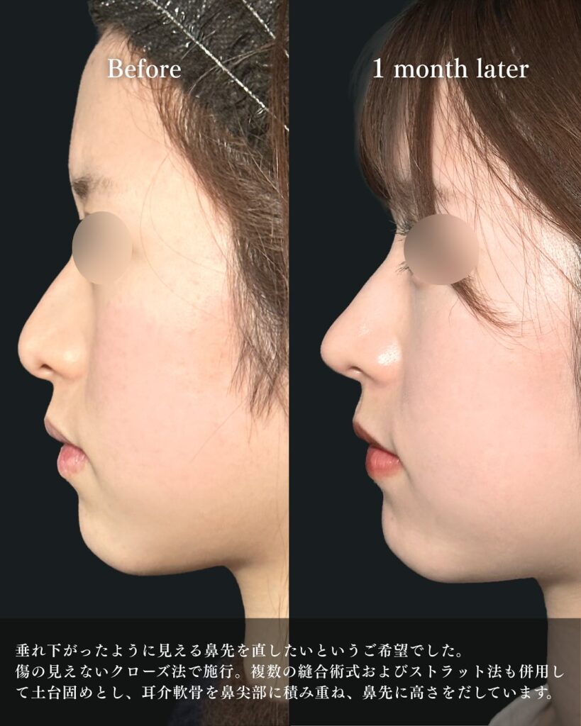 鼻尖形成と軟骨移植とプロテーゼの症例写真 (16)