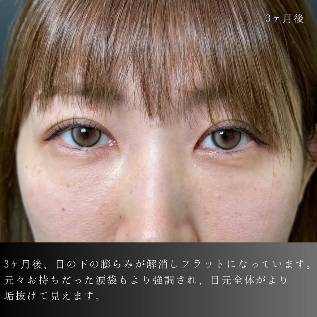 裏ハムラ法の症例写真 (65)
