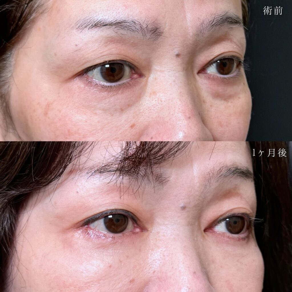 裏ハムラ法の症例写真 (69)