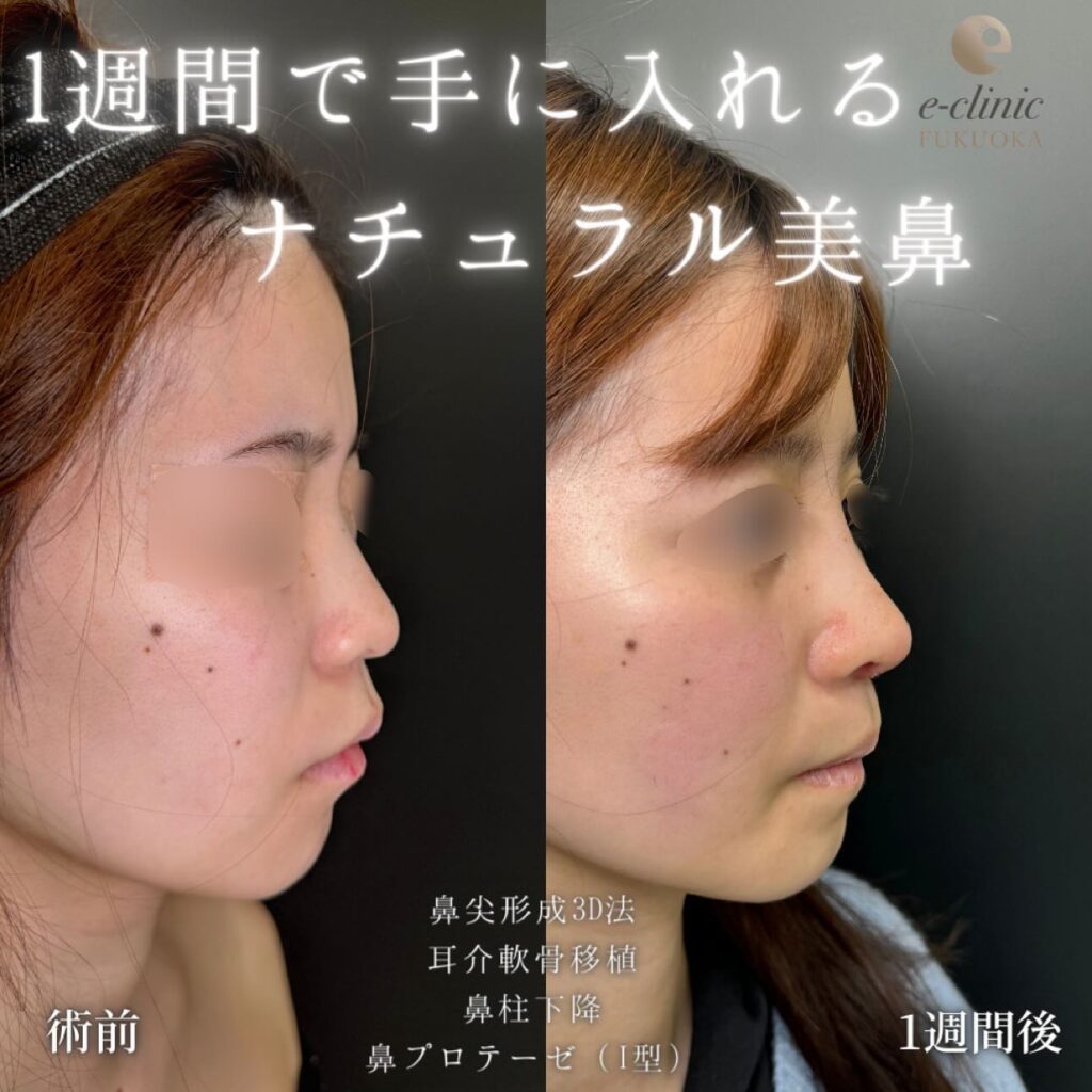 鼻尖形成と軟骨移植とプロテーゼと鼻柱下降の症例写真 (1)