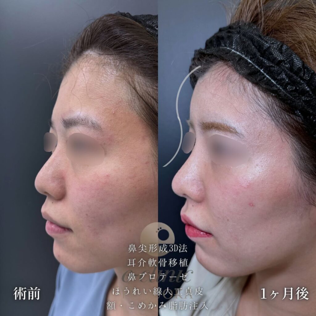 鼻尖形成と軟骨移植とプロテーゼと人工真皮と脂肪注入の症例写真 (3)