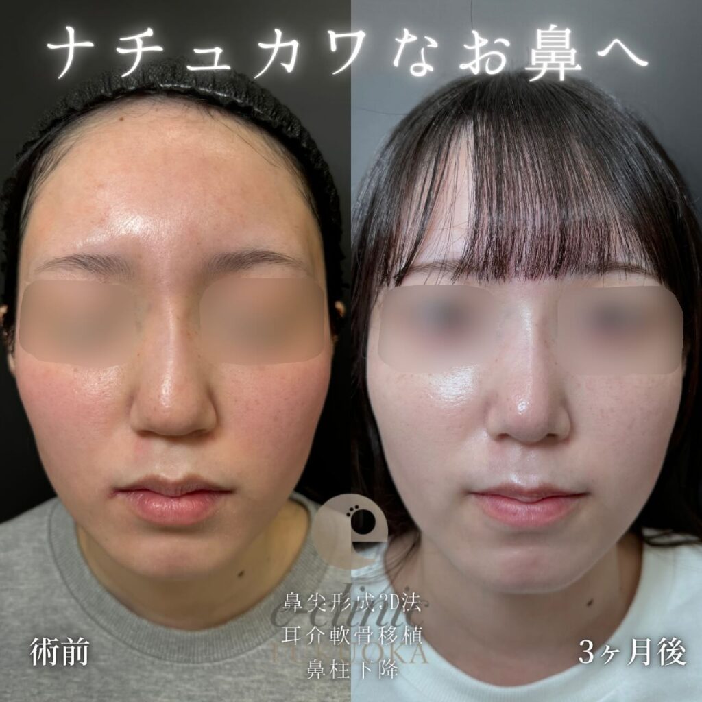 鼻尖形成と耳介軟骨移植と鼻柱下降の症例写真 (1)