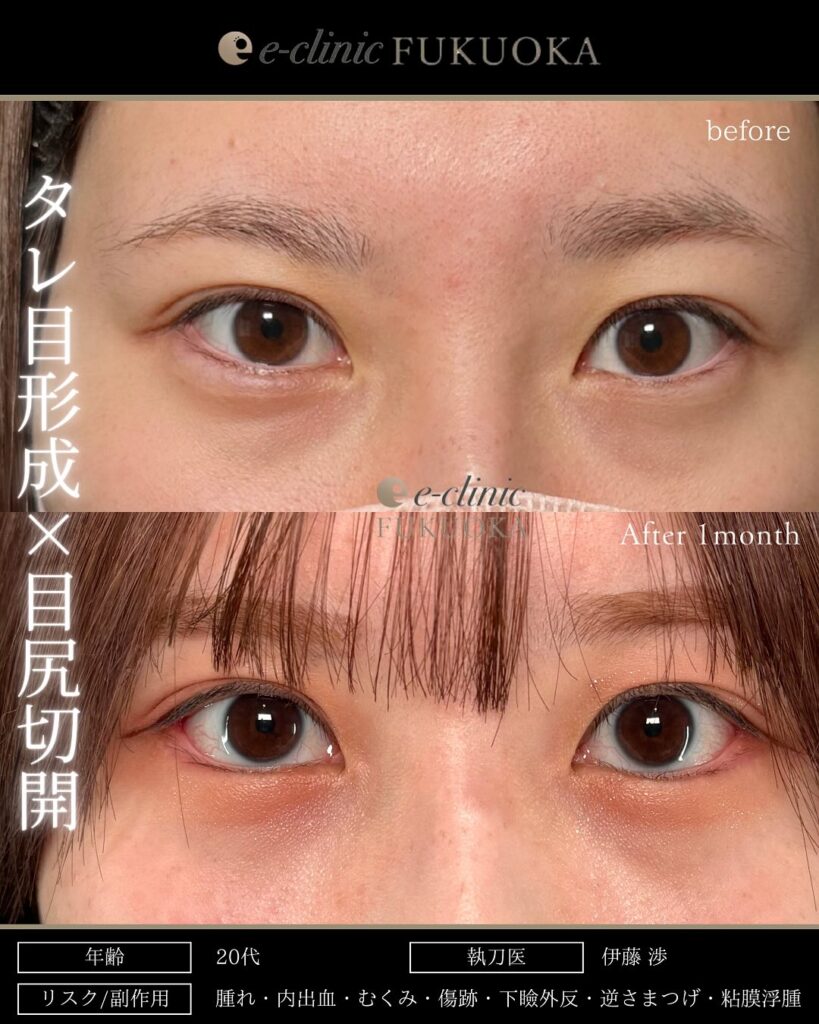 タレ目形成と目尻切開の症例写真 (8)