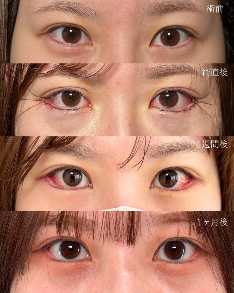 タレ目形成と目尻切開の症例写真 (9)