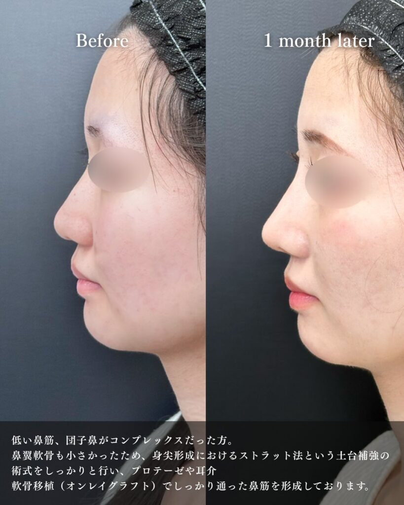 鼻尖形成と軟骨移植とプロテーゼの症例写真 (10)